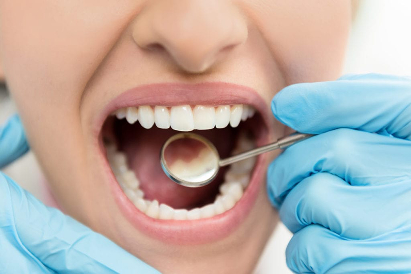 Dental Fillings in Lochgilphead at Union Street Dental